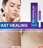 Wart Remover Skin Pen Gel